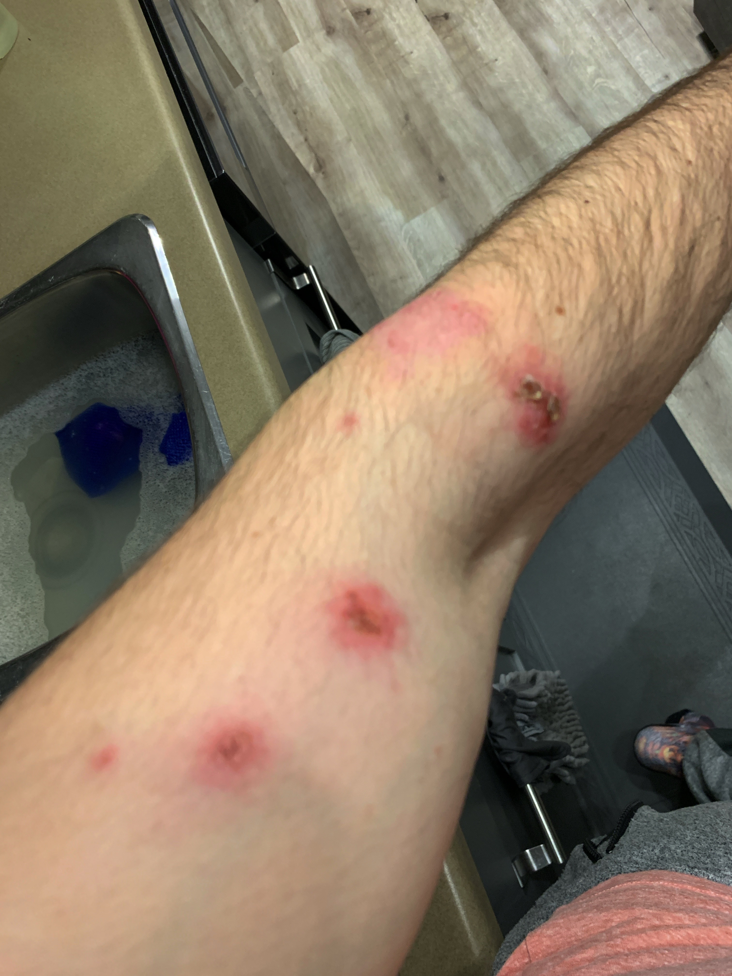 JF's arm skin infection in February 2019 before red light therapy